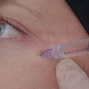Mesoterapia Nanosoft