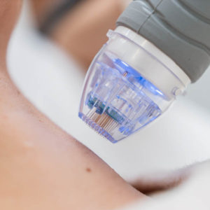 Micropunción Facial, Corporal y Capilar
