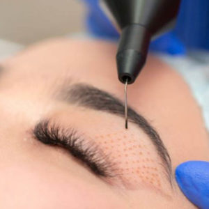 Plasma Pen Facial y Corporal