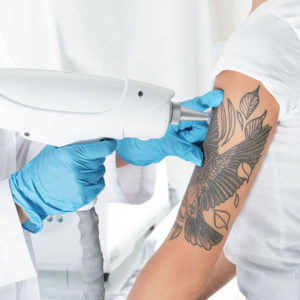 Eliminación de tatuajes con Láser Q-Switch